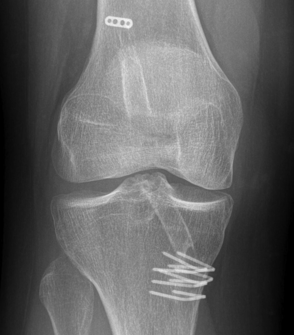 ACL Failure Graft Too Vertical